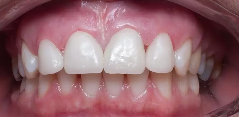 Coroane E-MAX realizate în laboratorul dentar