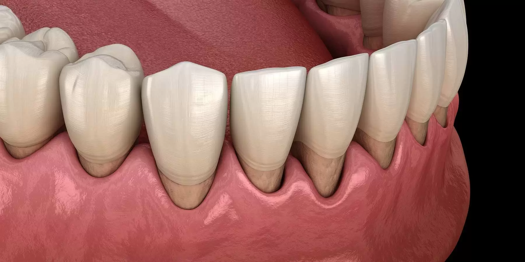 retracție gingivala boală parodontală