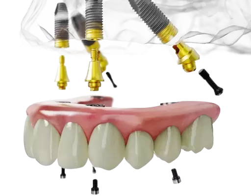 All on 4 Nobel Biocare concept implants