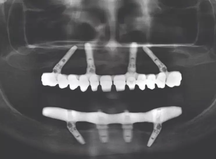 radiografie dentara panoramica a 4 implanturi pe care este fixata o punte, exemplificând coceptul all on 4