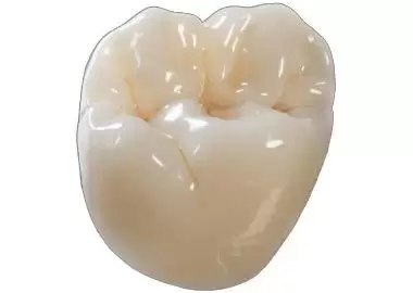 coroană pe baza de oxid de zirconiu stratificată cu ceramică