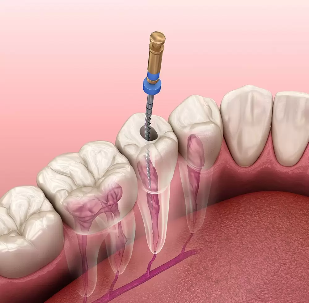 curățarea canalelor dentare