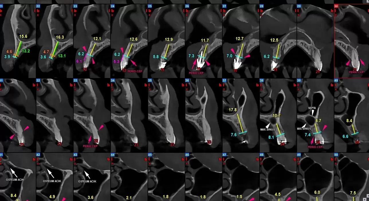 tomografie compiuterizată cbct