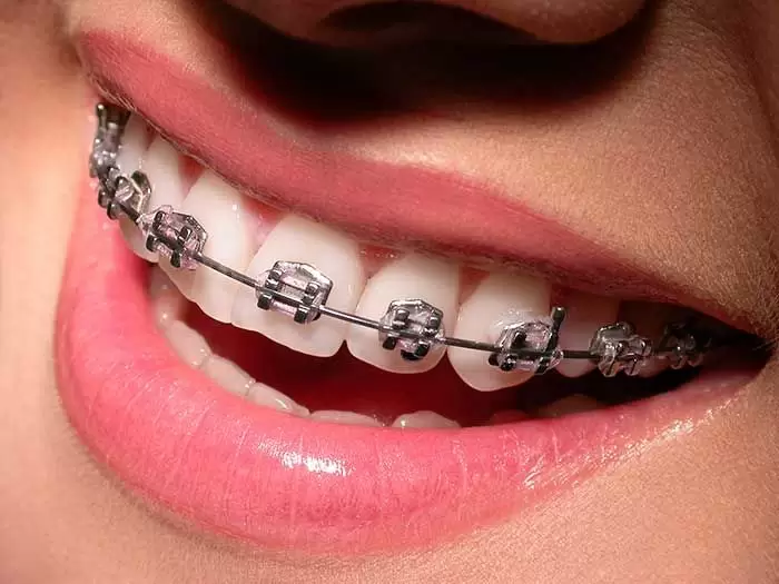 aparat dentar de tip bracket metalic